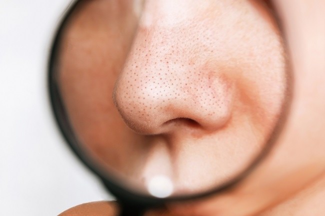 Tips Mudah Hilangkan Komedo di Hidung dengan Bahan Alami di Rumah