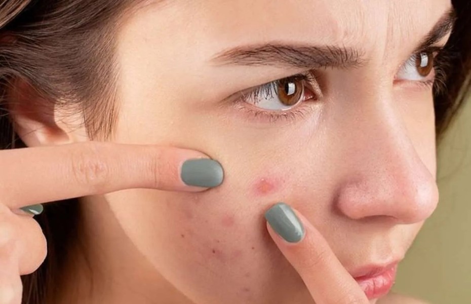 Jerawat Muncul Setelah Memakai Sunscreen? Ini Empat Penyebab yang Sering Terjadi